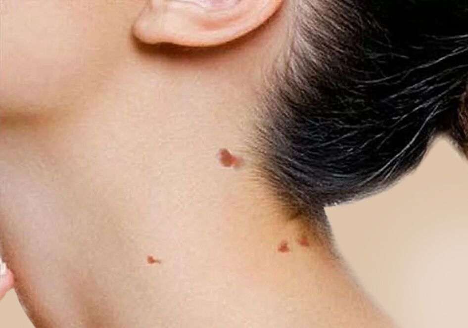 L'apparition de papillomes sur le cou après l'activation du VPH dans le corps