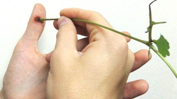 Cautérisation du papillome sur le doigt avec du jus de chélidoine