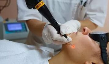 Une procédure efficace pour éliminer le papillome sur le visage avec un laser