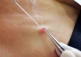 Retrait au laser