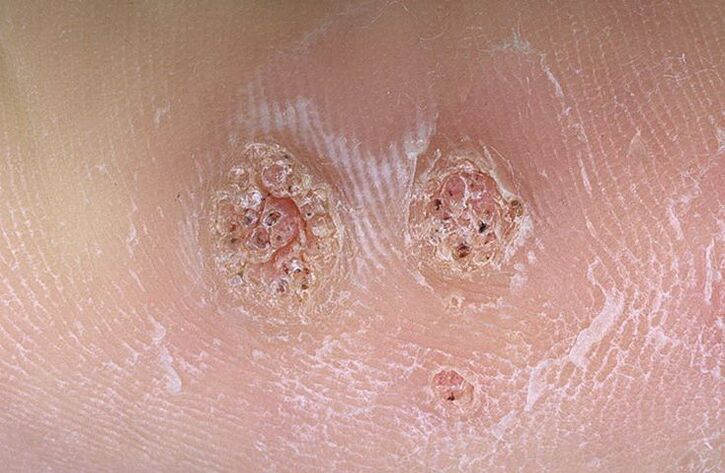 verrues sur le corps