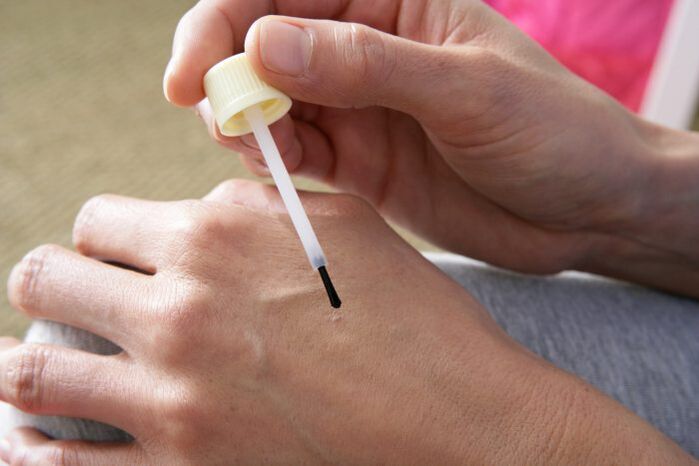 cautérisation des verrues avec du jus de chélidoine